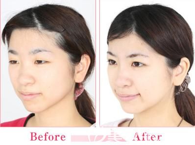 慫恿閨蜜陪我到日本中央整形做埋線雙眼皮后 給大家分享四組對(duì)比圖看效果是不是自然的不像話