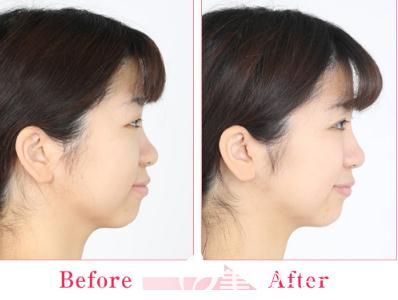 日本中央整形做埋線雙眼皮側(cè)面