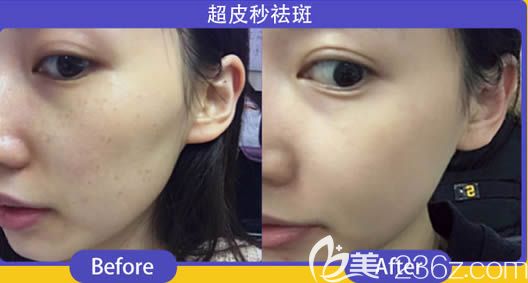 福州臺(tái)江陳麗萍激光祛斑三個(gè)月對(duì)比效果