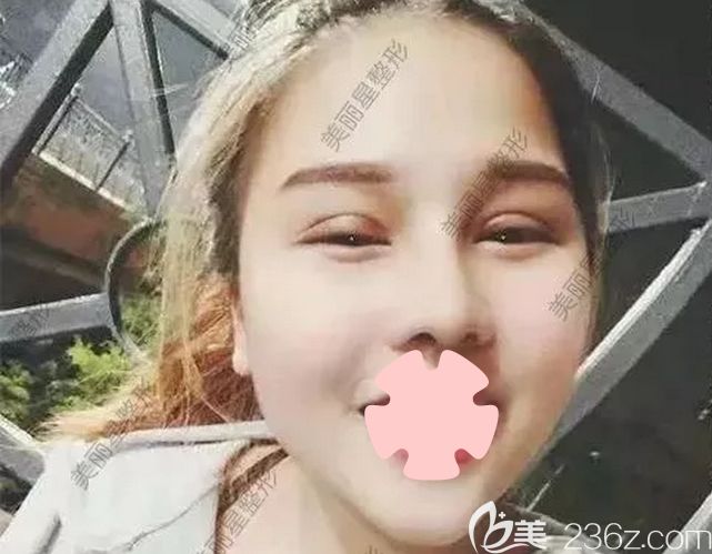 我在南寧美麗星做雙眼皮和隆鼻第7天拆線照片 我在南寧美麗星做雙眼皮和隆鼻第7天拆線照片