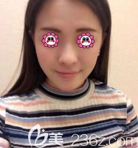 在北京惠合嘉美做玻尿酸墊下巴前樣子 在北京惠合嘉美做玻尿酸墊下巴前樣子