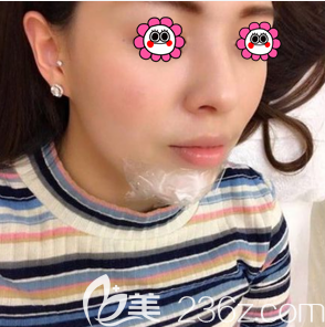 <!--<i data=20240703-sp></i>-->醫(yī)生給我做玻尿酸墊下巴當(dāng)天敷麻樣子 <!--<i data=20240703-sp></i>-->醫(yī)生給我做玻尿酸墊下巴當(dāng)天敷麻樣子