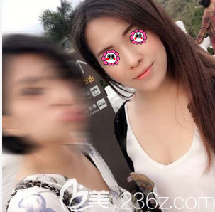 北京惠合嘉美醫(yī)院玻尿酸墊下巴案例 北京惠合嘉美醫(yī)院玻尿酸墊下巴案例