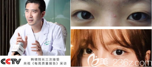 濟(jì)南海嘯雙眼皮案例