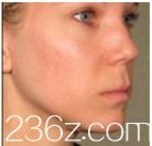 到日本朝日美容外科做了去松弛，輕松帶走衰老痕跡