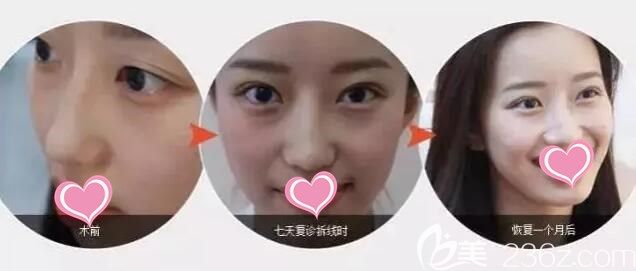 無痕媚眼雙眼皮一個月的恢復效果圖