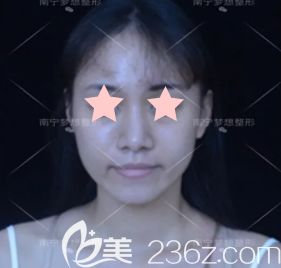 我在南寧夢想整形打瘦臉前的照片 我在南寧夢想整形打瘦臉前的照片