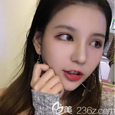 廣州藝美李闖隆鼻案例7天拆線