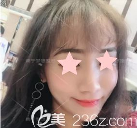  看了自己在南寧夢(mèng)想整形打瘦臉除皺瘦臉+玻尿酸前后對(duì)比照片，感覺挺靠譜