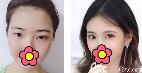 蘭州時光相伴張曉萍院長全切雙眼皮+開眼角<span style=