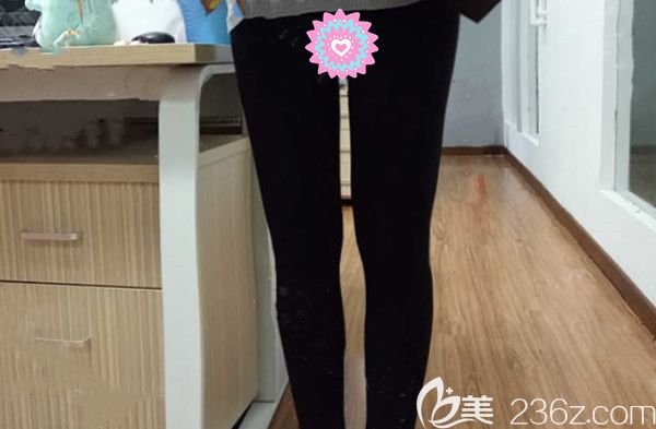 蘭州時光相伴整形醫(yī)院大腿吸脂三個月<span style= 蘭州時光相伴整形醫(yī)院大腿吸脂三個月<span style=