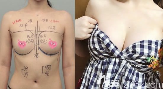美國曼托假體300cc隆胸案例