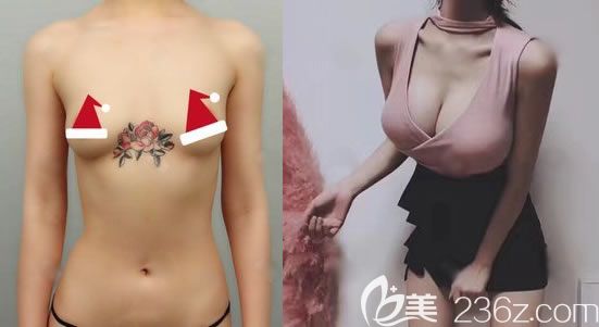 美國曼托水滴型假體350cc案例效果