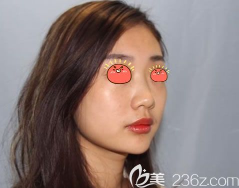 寧波薇琳醫(yī)美做假體隆鼻前 寧波薇琳醫(yī)美做假體隆鼻前