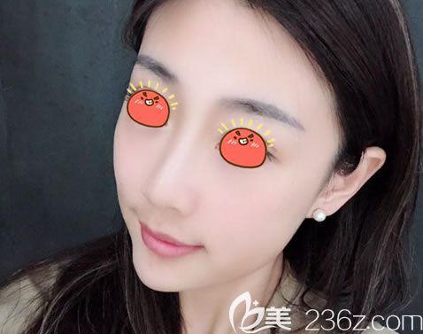 寧波薇琳整形做隆鼻2周<span style= 寧波薇琳整形做隆鼻2周<span style=