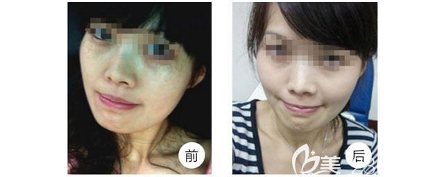 金良夏醫(yī)生祛斑案例
