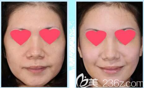 金良夏醫(yī)生除皺案例對(duì)比