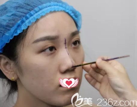 荊萬里醫(yī)生為我做鼻綜合術(shù)前設計