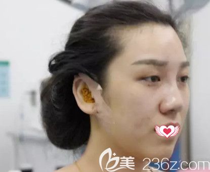 荊萬里醫(yī)生為我做鼻綜合術(shù)后鼻子微腫