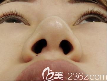 水之森鼻尖縮小術(shù)前