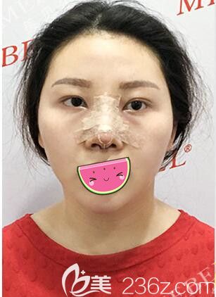 陳剛醫(yī)生做完鼻綜合術(shù)后即刻效果