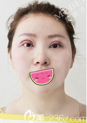 做完鼻綜合術(shù)后5天又做了眼綜合整形