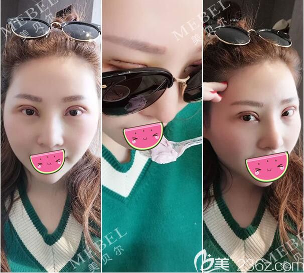 眼綜合術(shù)后三天，鼻子好像腫脹消除很快但眼睛還在恢復(fù)中