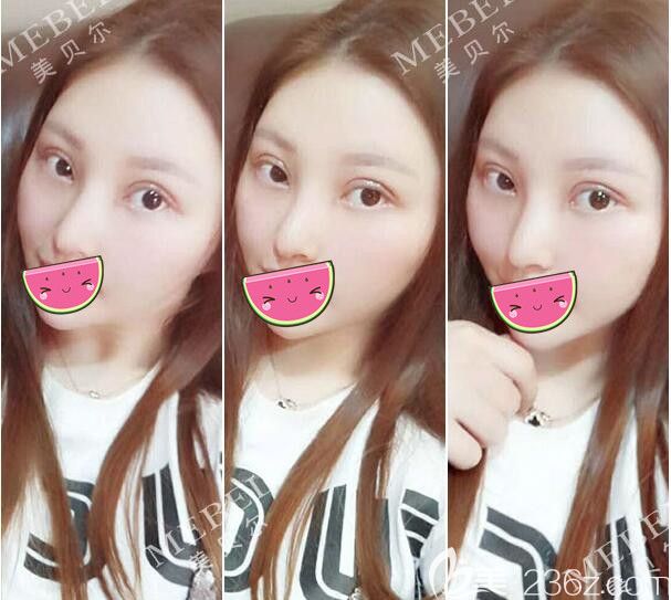 找陳剛醫(yī)生做眼綜合術(shù)后一周鼻綜合術(shù)后快兩周恢復(fù)