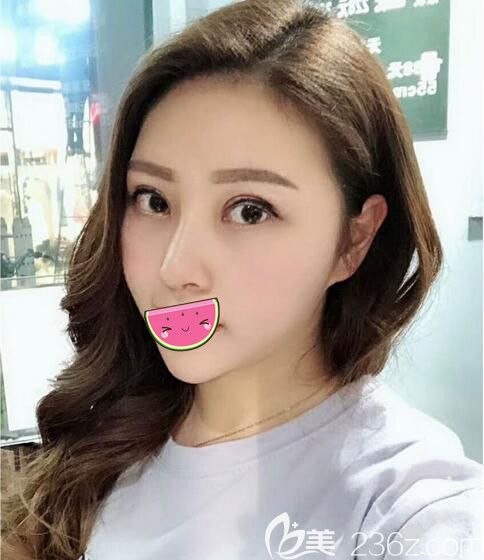 聽說南京美貝爾整形有特惠活動(dòng)，面診院長做了眼綜合+鼻綜合總共才不到2萬塊錢