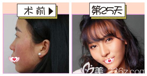 陳遠琨醫(yī)生做鼻綜合案例