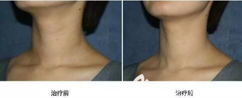 海南華美微針套組祛頸紋真人前后對比效果
