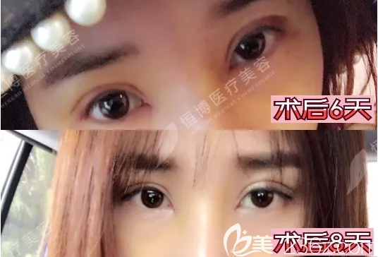 雙眼皮開眼角拆線后效果 雙眼皮開眼角拆線后效果