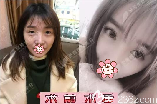 成都恒博雙眼皮開眼角術(shù)前術(shù)后效果對比 成都恒博雙眼皮開眼角術(shù)前術(shù)后效果對比