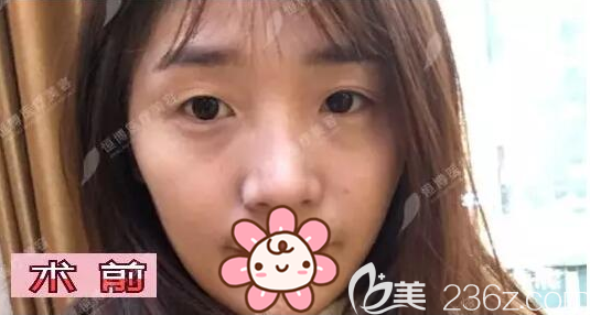 在<!--<i data=20240703-sp></i>-->做雙眼皮手術(shù)前的照片 在<!--<i data=20240703-sp></i>-->做雙眼皮手術(shù)前的照片