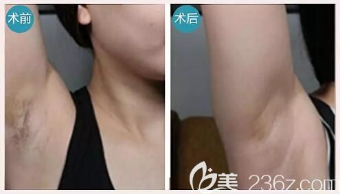 海南華美脫腋毛真人前后效果展示