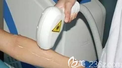 激光脫毛的過程