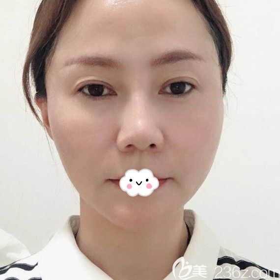 武漢美基元埋線提升術(shù)后第1天