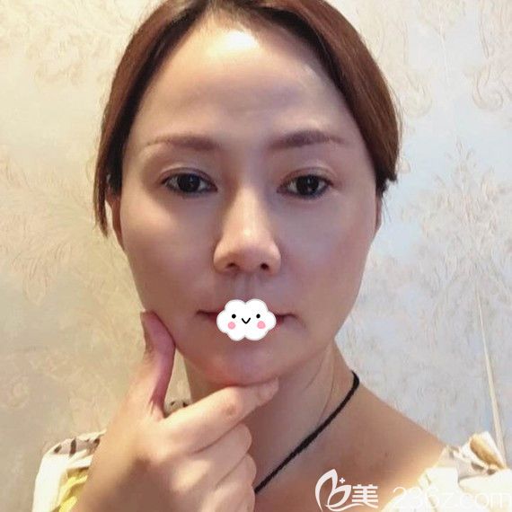 武漢美基元面部年輕化真人案例