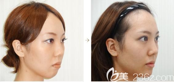 日本水之森做假體墊下巴正側(cè)面對(duì)比 日本水之森做假體墊下巴正側(cè)面對(duì)比