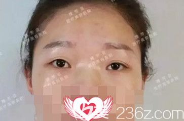 在石家莊雅芳亞做雙眼皮術(shù)前眼皮松弛下垂 在石家莊雅芳亞做雙眼皮術(shù)前眼皮松弛下垂