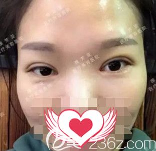 雅芳亞整形院長(zhǎng)王文明做切開(kāi)雙眼皮術(shù)后7天拆線 雅芳亞整形院長(zhǎng)王文明做切開(kāi)雙眼皮術(shù)后7天拆線