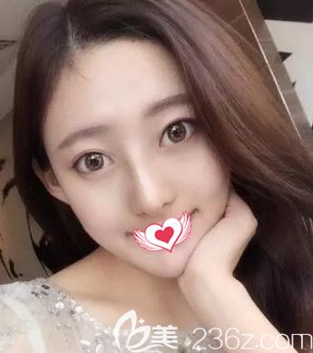 丁慶豐院長做鼻綜合術(shù)后15天鼻子完全消腫 丁慶豐院長做鼻綜合術(shù)后15天鼻子完全消腫