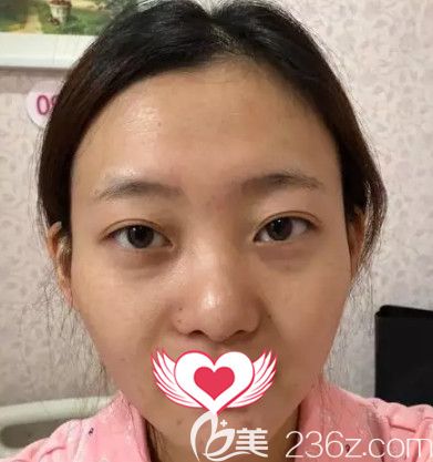 在石家莊雅芳亞做鼻綜合前是塌鼻子 在石家莊雅芳亞做鼻綜合前是塌鼻子