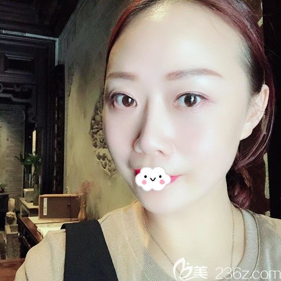 武漢美基元去眼袋案例術(shù)后效果圖