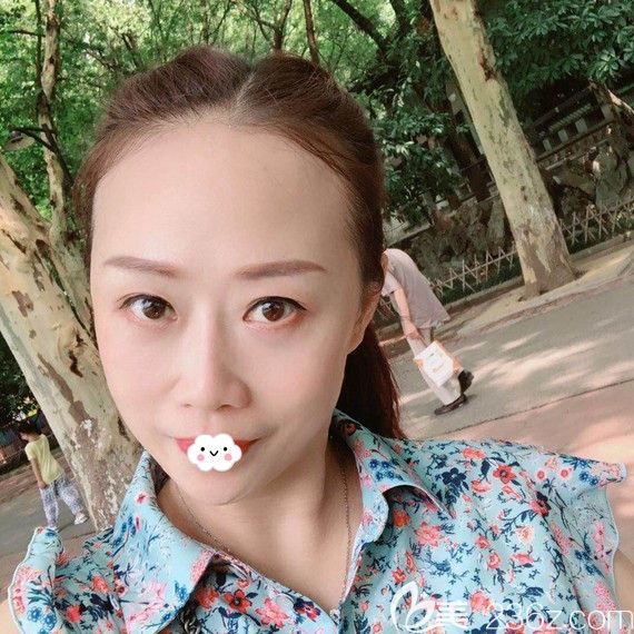 武漢美基元去眼袋術(shù)后恢復(fù)照片