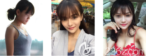 貴陽美貝爾假體隆胸案例