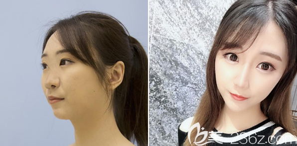 佛山佳麗于立民做的鼻綜合隆鼻案例 佛山佳麗于立民做的鼻綜合隆鼻案例