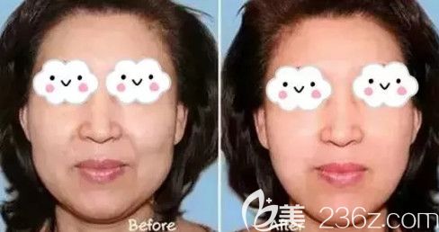 王萌醫(yī)生除皺案例