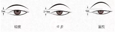 上瞼下垂三種程度