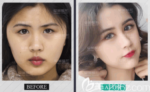 重慶軍美胡金香雙眼皮案例